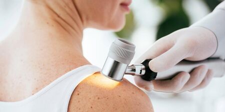 L’importanza del controllo dei nei: prevenzione e diagnosi precoce